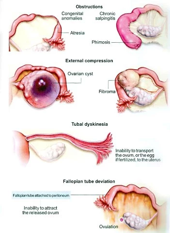 Tubal factors causing Infertility in Women